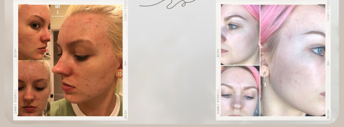 My Journey with Lymecycline